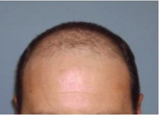 eClinic Haartransplantaties | Haartransplantatie Man