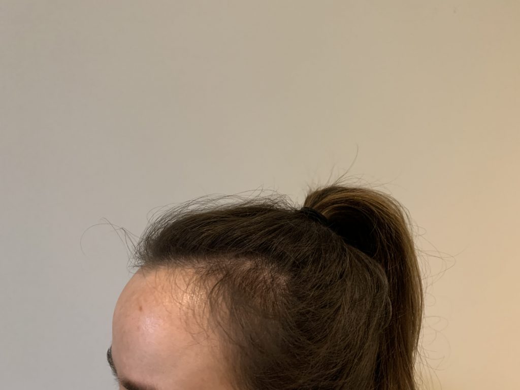 eClinic Haartransplantaties | Haartransplantatie vrouw