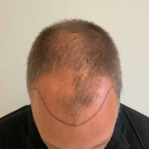 eClinic Haartransplantaties | Resultaten