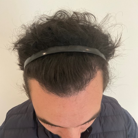 eClinic Haartransplantaties | Haartransplantatie Man