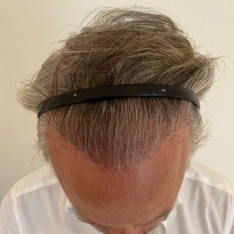 eClinic Haartransplantaties | Haartransplantatie Man