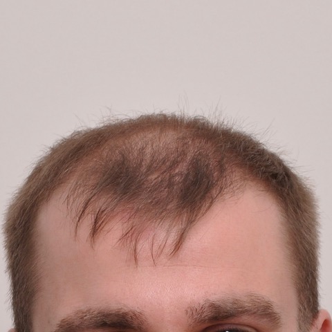 eClinic Haartransplantaties | Haartransplantatie Man