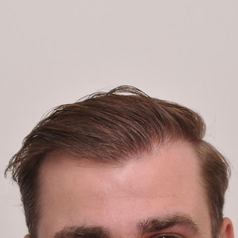 eClinic Haartransplantaties | Haartransplantatie Man