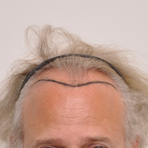 eClinic Haartransplantaties | Haartransplantatie Man