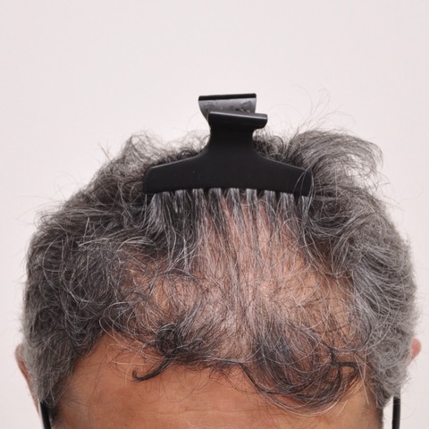 eClinic Haartransplantaties | Haartransplantatie Man