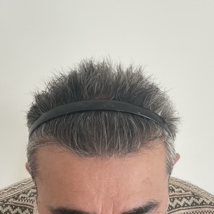 eClinic Haartransplantaties | Haartransplantatie Man