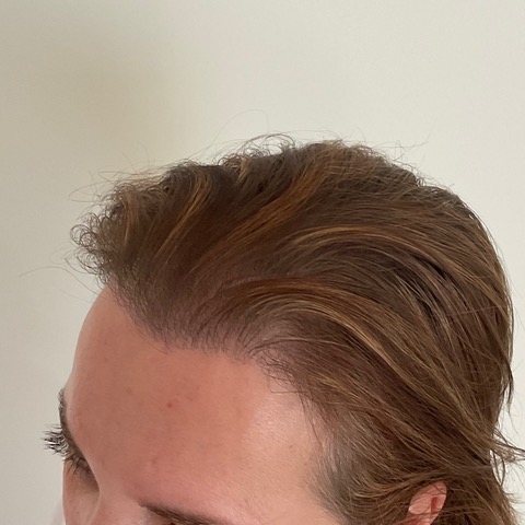 eClinic Haartransplantaties | Haartransplantatie vrouw