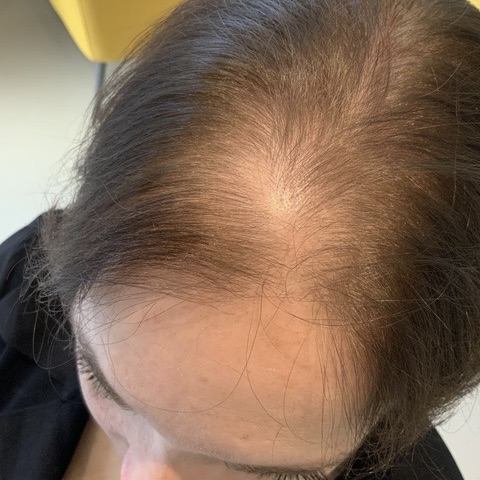 eClinic Haartransplantaties | Haartransplantatie vrouw