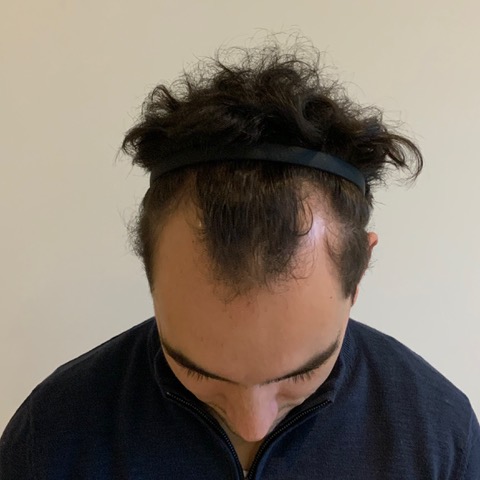 eClinic Haartransplantaties | Haartransplantatie Man